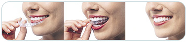 www.kapa.ru - Индивидуальные зубные капы